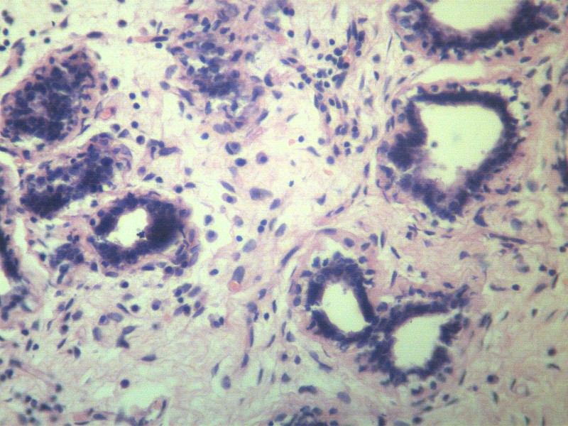 乳腺纤维腺瘤 显微切片图片