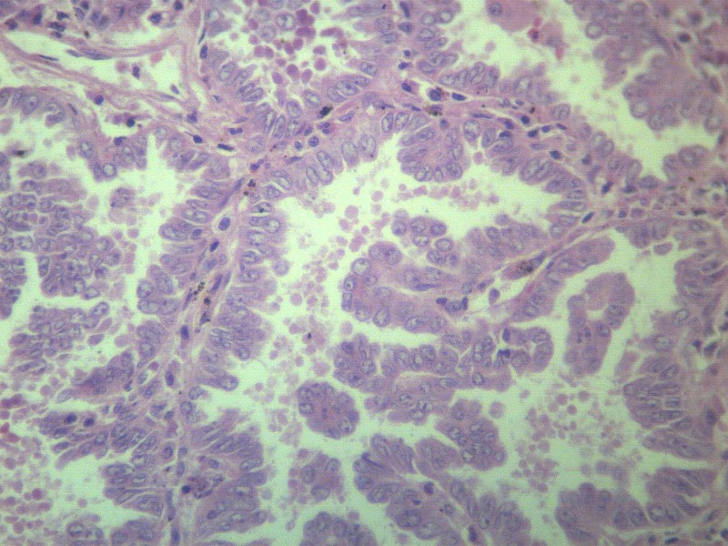 腺癌 显微切片图片