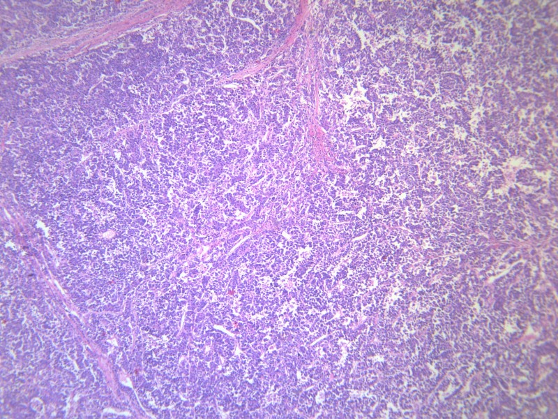 淋巴结内转移癌 显微图片