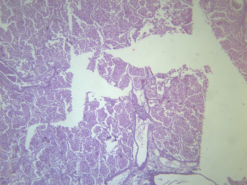 大叶性肺炎 显微图片