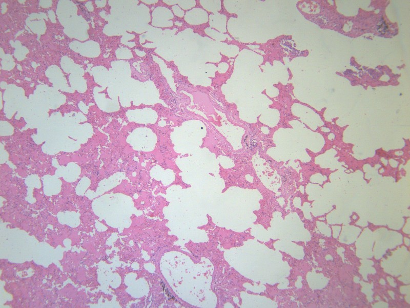 小叶性肺炎 显微图片