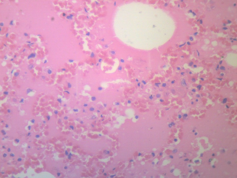 小叶性肺炎 显微图片