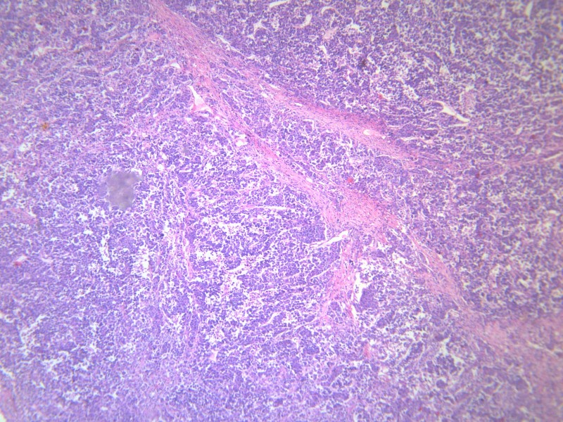 淋巴结内转移癌 显微图片