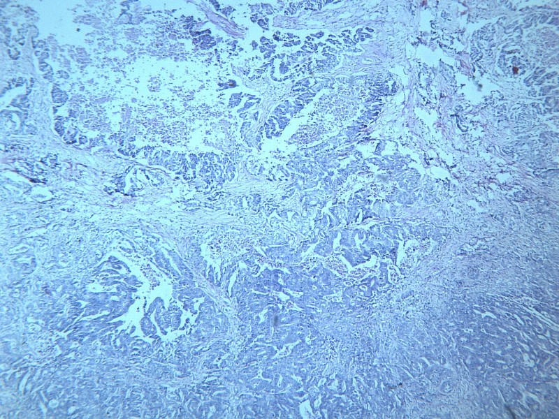 腺癌肝转移 显微图片