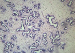 乳腺纖維腺瘤 顯微切片圖片(11張)