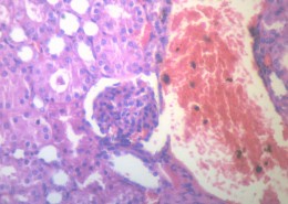 腎凝固性壞死 顯微切片圖片(17張)