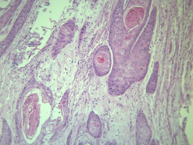 高分化鱗癌 顯微切片圖片