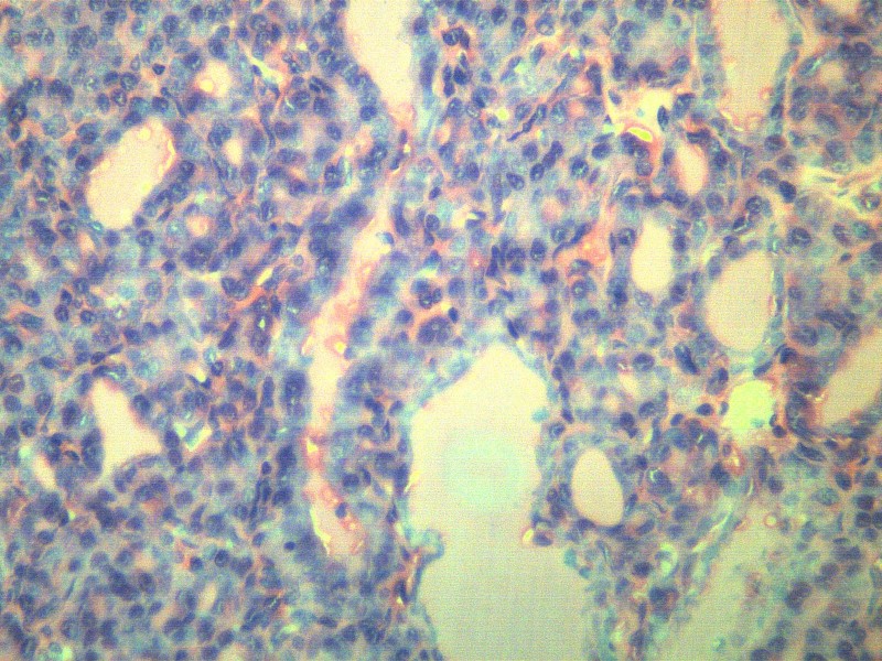 甲狀腺瘤 顯微切片圖片
