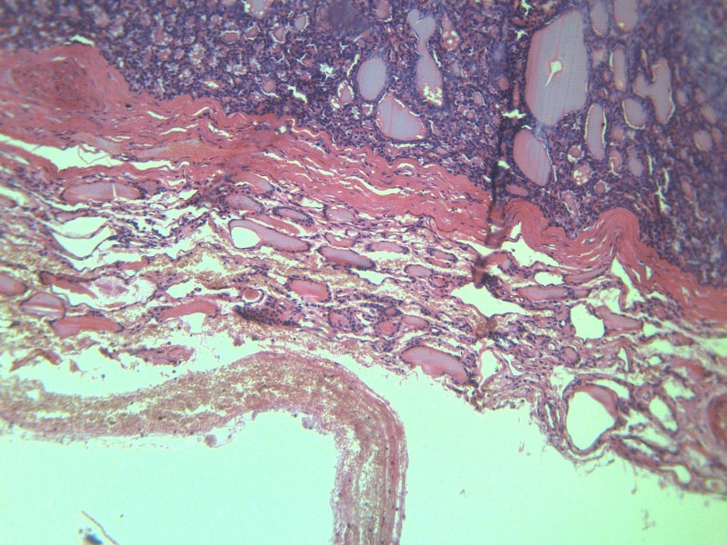 甲状腺瘤 显微切片图片