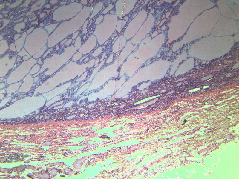 甲狀腺瘤 顯微切片圖片