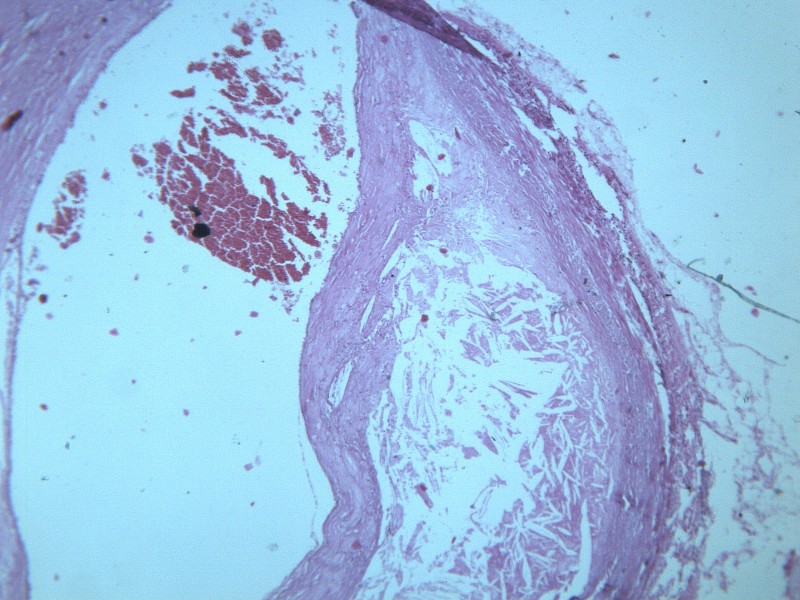 动脉粥样硬化 显微图片