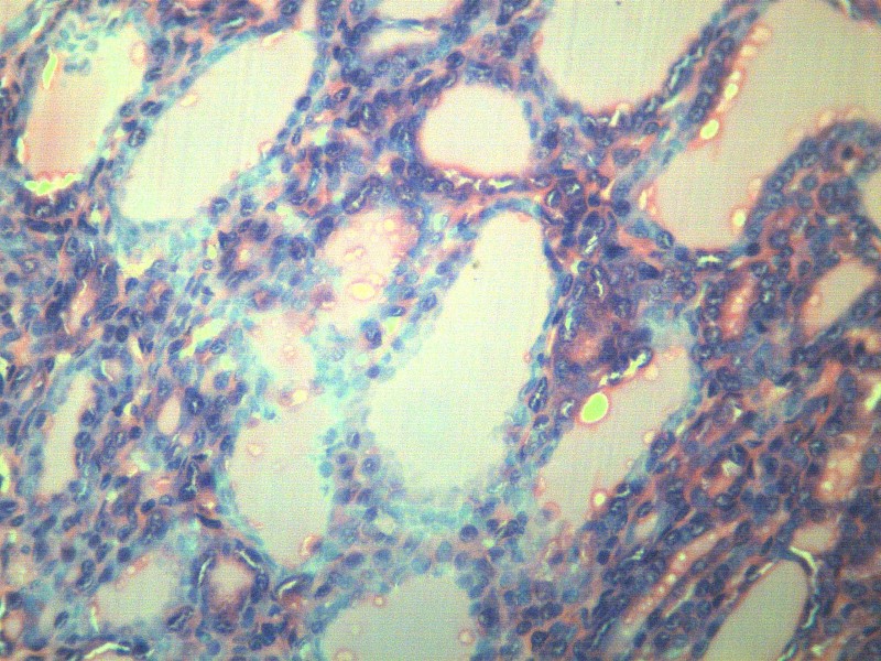 甲狀腺瘤 顯微切片圖片