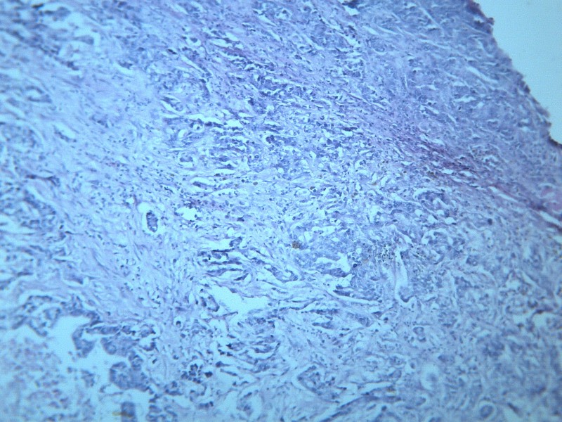 腺癌肝转移 显微图片